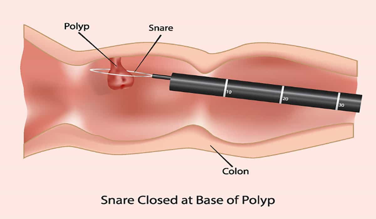 Сколько длится удаление полипов в матке. Гистероскопия полипэктомия. Полип эндометрия гистероскопия. Гистероскопия с биопсией.